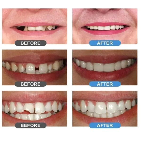 معجون حشوات الراتنج للأسنان moldable false teeth