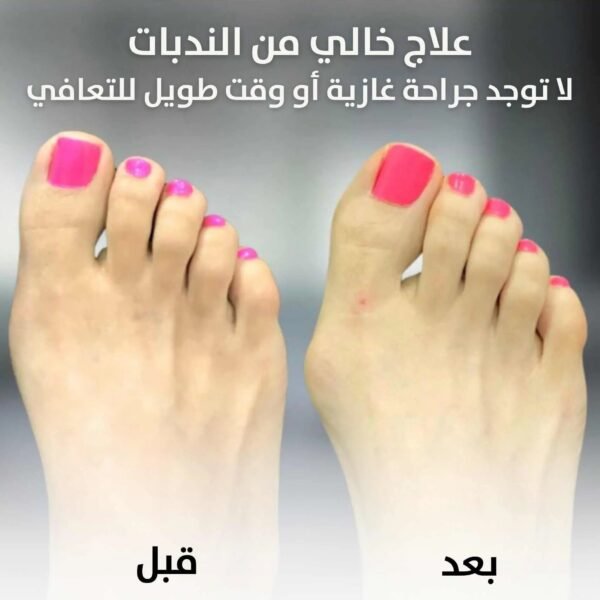 مصحح لأصابع القدم Bunion Corrector Relief Orthopedic Splint