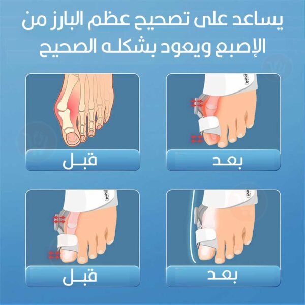 مصحح لتعديل أصبع القدم (الإبهام) Bunnion corrector